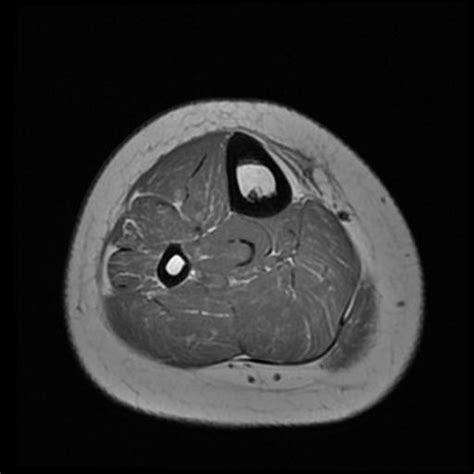 Osteochondroma Tibia Image