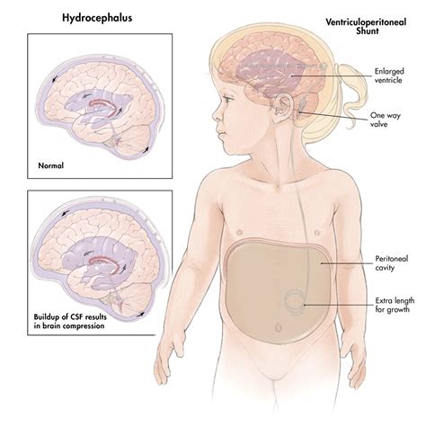 Indications For Vp Shunt In Adults