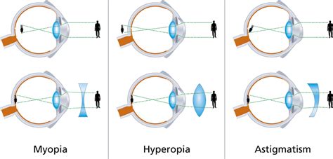 5 Things You Need To Know About Having An Astigmatism Brinton Vision St Louis Best Lasik