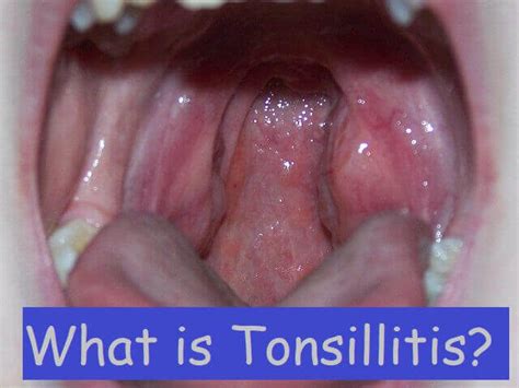 What Is Tonsillitis Definition Causes Symptoms And Surgery 2021