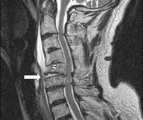 Spectrum Of Imaging Findings In Hyperextension Injuries Of The Neck