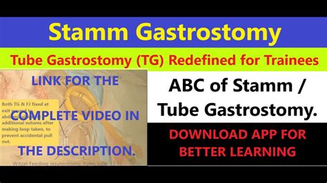 Stamm Tube Gastrostomy Tg Fj Series Part See Video