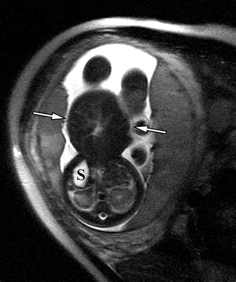 Prenatal Mri Of Congenital Abdominal And Chest Wall Defects Ajr