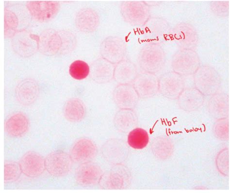 Screening And Haematology Flashcards Quizlet