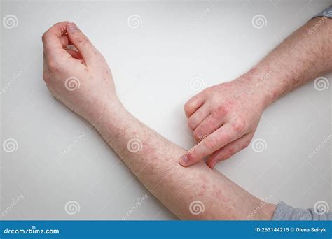 Patient Showing Red Itchy Rash On Hands And Arms Dermatitis Eczema