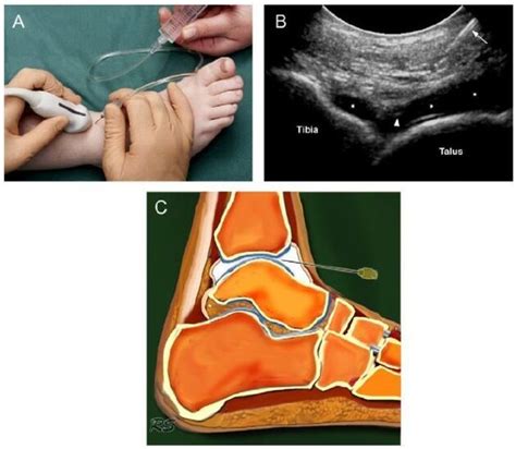 Artrose Do Tornozelo Sintomas E Tratamento Hondrogel