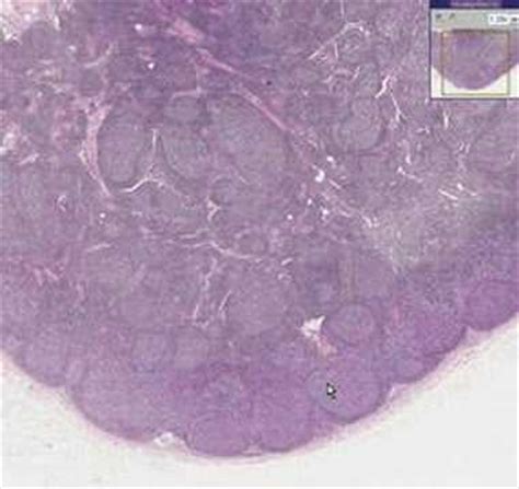 Histopathology Lymph Node Acute Lymphadenitis