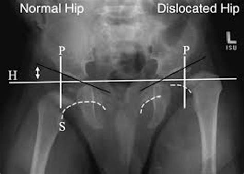 Developmental Dysplasia Of Hip Or Congenital Dislocation Of Hip Bone