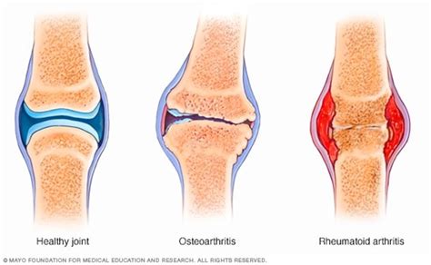 Maintaining Healthy Pain Free Joints With Genuwell Joint Health Kondor Pharma