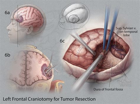 Left Frontal Craniotomy For Tumor Resection Alisa Brandt S Portfolio