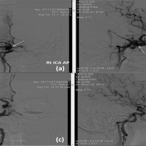 Cerebral Angiography A Anteroposterior Ap View B Lateral View