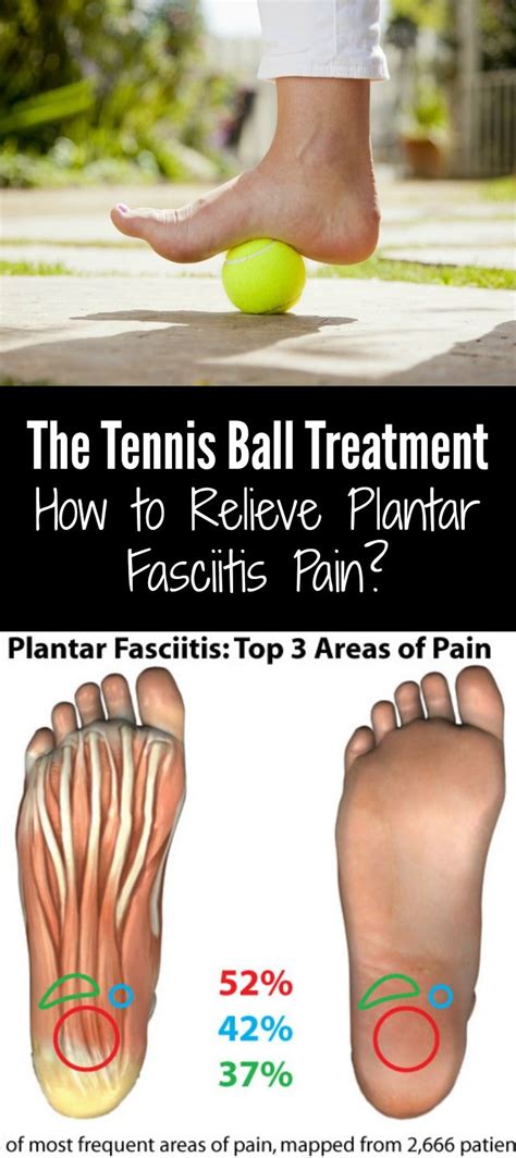 Plantar Fasciitis Treatment Artofit