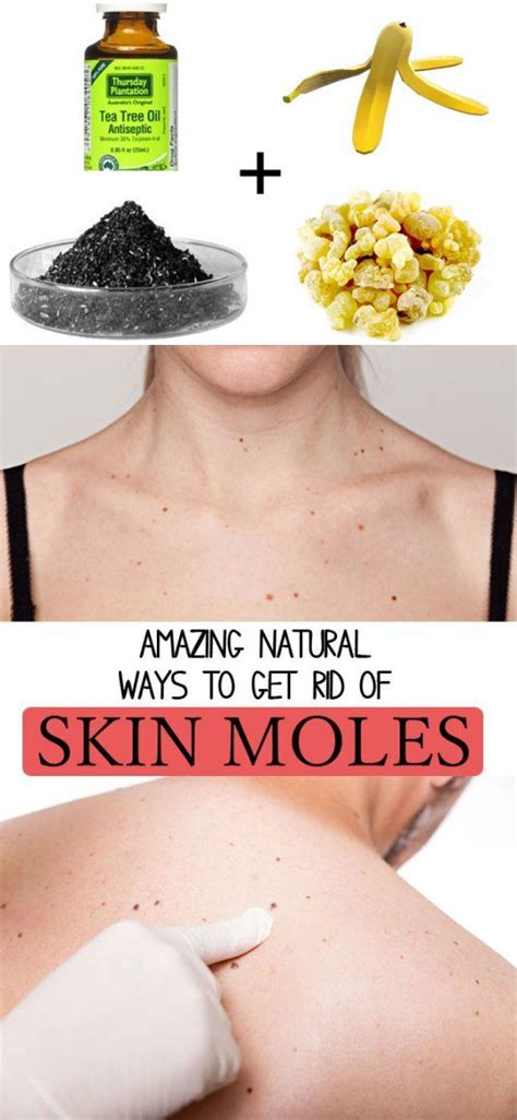 How To Remove Moles Quickly Skin Moles Mole Removal