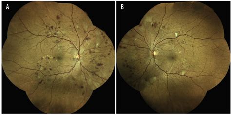 Standard Tools And Tests For Diagnosing Diabetic Retinopathy Modern