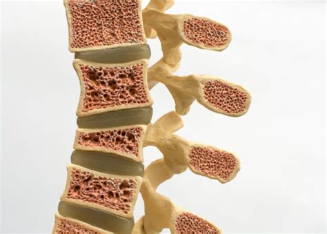 Managing Osteoporotic Compression Fractures | National Spine Health Foundation