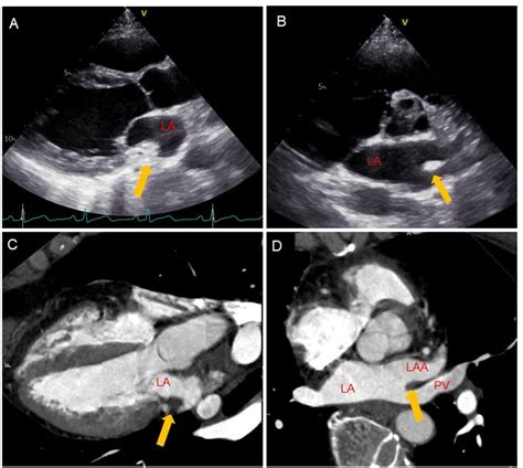 The Utility Of Cardiac Computed Tomography In Distinguishing A Coumadin