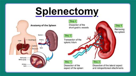 Appendectomy Liberty Clinic