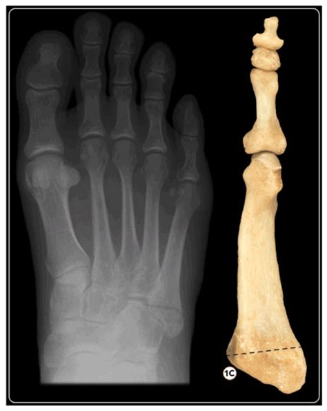 Fifth Metatarsal Fracture Treatment And Tips Metatarsal Fractures