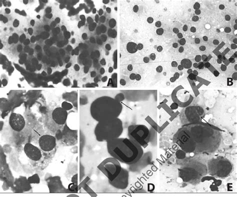 Smears Showing Cellular Features A Dissociated Plasmacytoid Cells Download Scientific