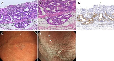 Fundic Gland Type Adenocarcinoma A Cancer Cells With Enlarged Nuclei