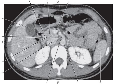 Axial Ct Of Abdomen With Cbd Diagram Quizlet