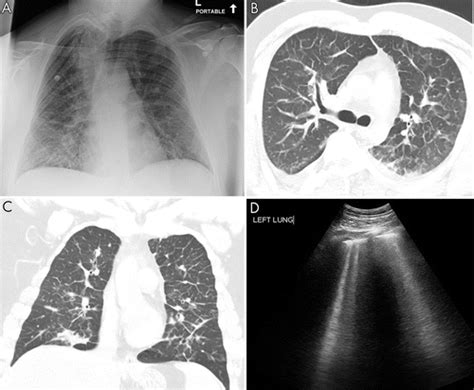 Lung Ultrasound The Essentials Radiology Cardiothoracic Imaging