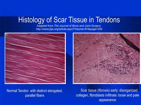 Ultrasound Guided Injectional Treatment of Scar Tissue, Bone Spurs, and