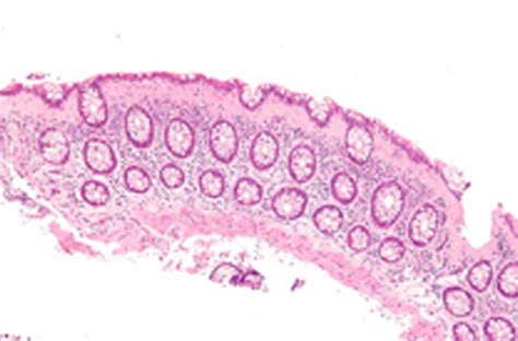 Microscopic Colitis