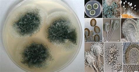 Aspergillus Clavatus Pulmonary Disease Fungal Spore Chronic