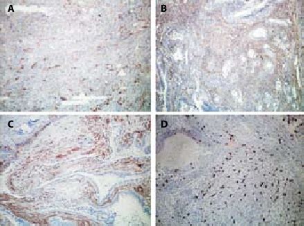 Hallazgos De Inmunohistoqu Mica En La Lesi N A Reactividad Del