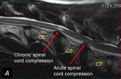 Cervical Myelopathy Physiopedia