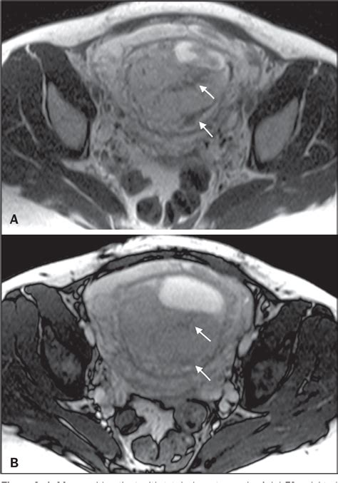 Figure 2 From Magnetic Resonance Imaging Findings In Placenta Accreta Spectrum Disorders