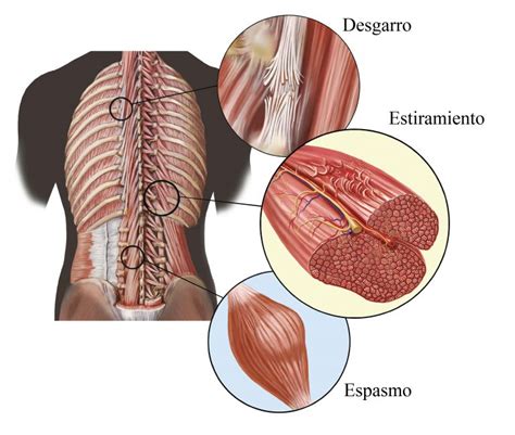 Contractura muscular descubre aquí qué es y cómo aliviarla