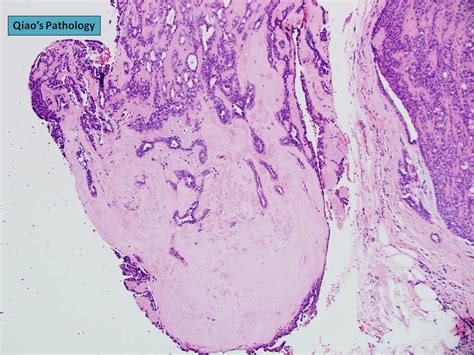 Qiao S Pathology Sclerosing Papilloma Of The Breast Flickr