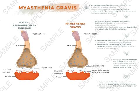 Myasthenia Gravis (printable) | Miss Medicine