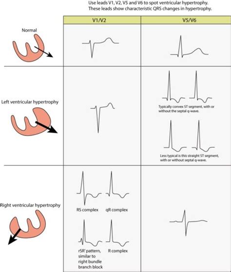 Right Ventricular Hypertrophy RVH ECG Criteria Clinical