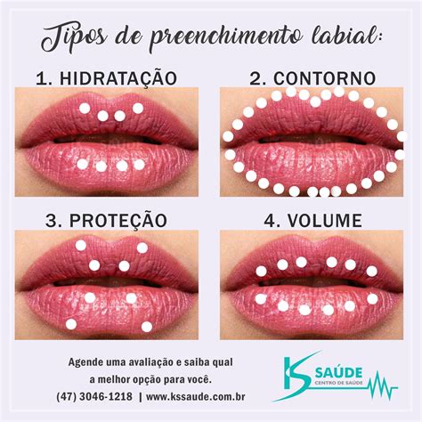 Gestante Pode Fazer Preenchimento Labial
