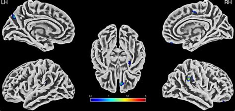 Paracentral Lobule Mri