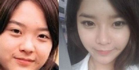 3 Amazing Asian Eye Surgery Before and After Transformations - Seoul ...