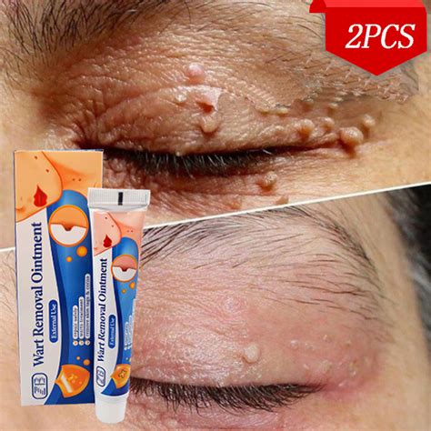 Buy Get Free Warts Remover Original Cream Warts Magic Remover Skin