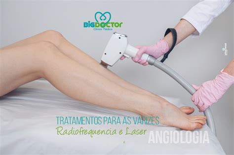 Tratamentos Para As Varizes Radiofrequência E Laser Clínica Big Doctor