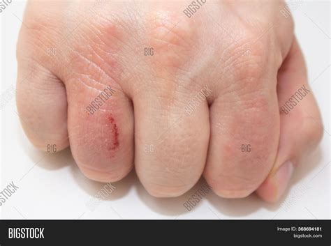 Hand Dermatitis. Hand Image & Photo (Free Trial) | Bigstock