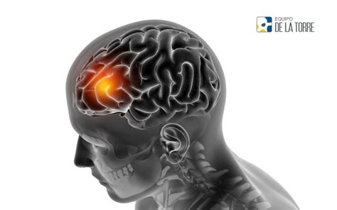 Tumor Cerebral Tipos Causas y tratamientos Neurocirugía de la Torre