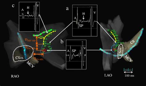 Anatomical And Electrophysiological Variations Of Kochs Triangle And The Impact On The Slow