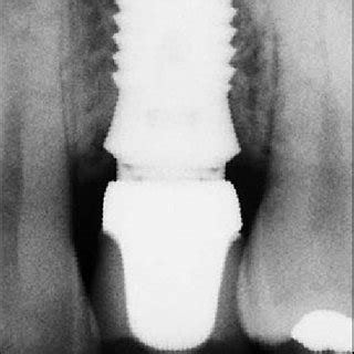 A Radiograph After Month Followup The Marginal Bone Is Stable