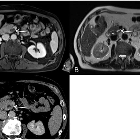 Pdf Pancreatitis Panniculitis And Polyarthritis Ppp Syndrome Caused By Post Pancreatitis