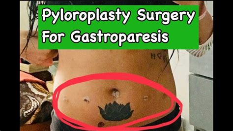 Plyloroplasty Surgery And Botox Injections For Gastroparesis