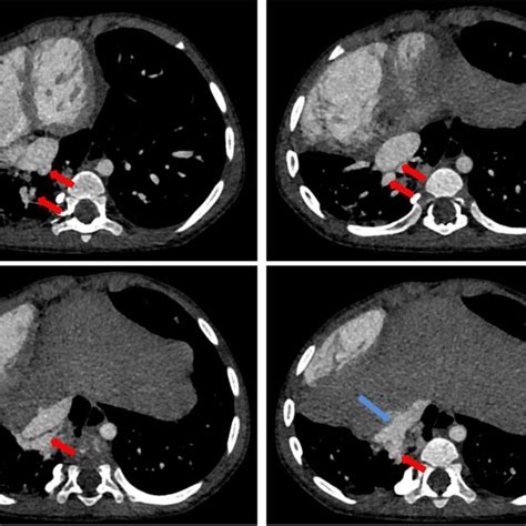 Contrast Enhanced Ct Of The Chest Contrast Enhanced Ct Shows The