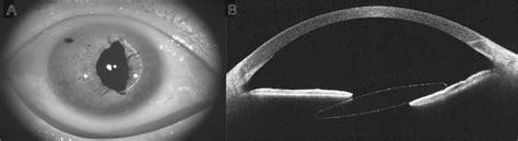 risk factors  pupillary optic capture  sutureles retina