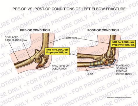 Pre Op Vs Post Op Conditions Of Left Elbow Fracture 95223d Generic Medical Legal Exhibits A